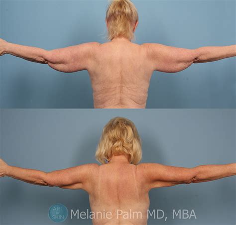 accusculpt     accusculpt san diego