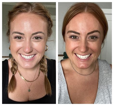 Unbelievable Blackhead Removal 2024: My Honest Review & Before/After Pics. Image 12