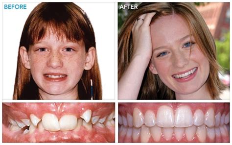 Before And After Braces: Before And After Braces Gifts