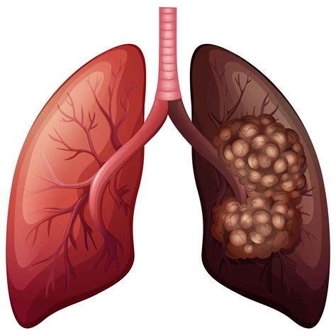 Detecting Early Lung Cancer | Pintas & Mullins