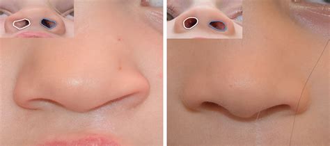 Primary Septal Cartilage Graft for the Unilateral Cleft Rhin ...