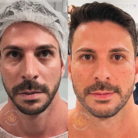 Redesignação Masculina Antes E Depois - Harmonização Facial Masculina em Fortaleza | Dra. Chris Marchetti ...