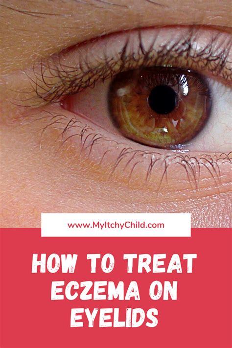 How To Treat Eczema On Eyelids Eczema On Eyelids How To Treat Eczema ...