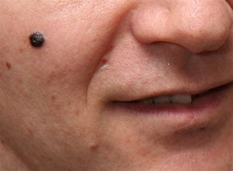 nodular melanoma skin cancer malignant melanoma skin cancer pictures