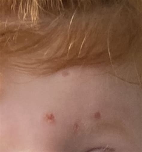 Chicken pox scars | Mumsnet