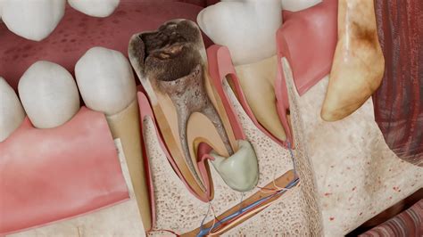 apical granuloma  symptoms  treatment  granuloma