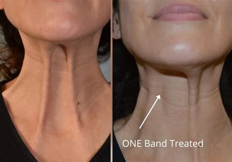 platysmal bands botox neck rejuvenation treatment