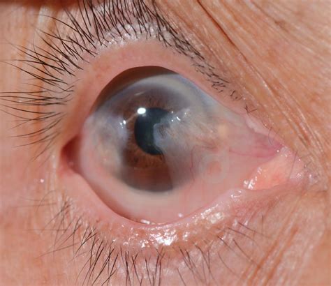 Cataract Awareness Month Drives Artificial Lenses Market | The Optical ...