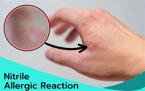 nitrile allergic reaction nitrile gloves info