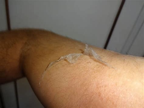 Skin Peeling After Laser Tattoo Removal: Essential Care Tips