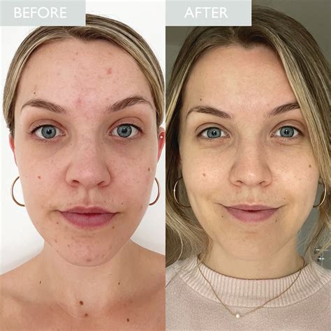 Zinc PCA Skin Care - Zinc PCA Benefits for Skin – SKINICIAN