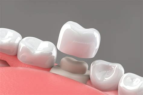 CEREC vs. Traditional Crowns