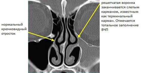 CLDH: Компьютерная томография анатомии носа и придаточных пазух. Аномалии