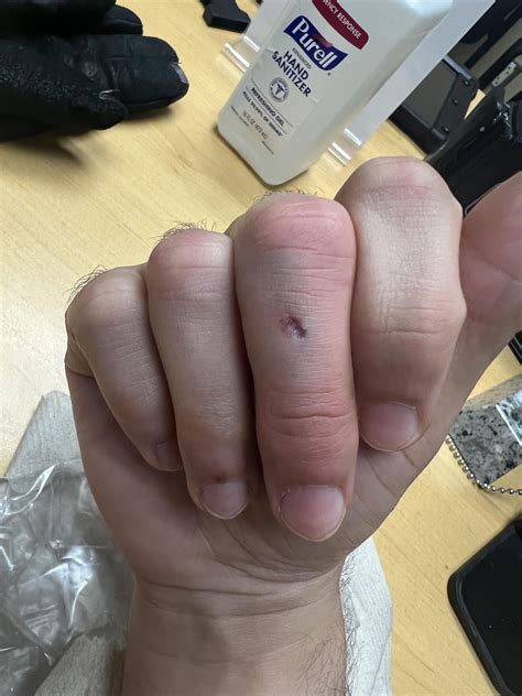 Bruised finger. Should I get this checked out? : r/medical_advice