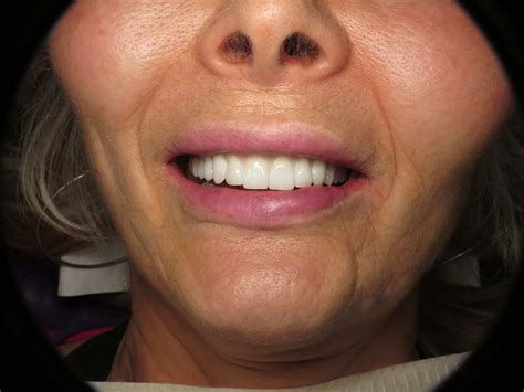 Pterygoid Implants To Avoid Zygomatic Implants And Sinus Lifting