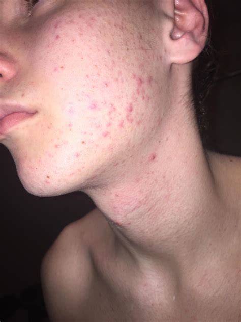 You'll Be Addicted After Watching This Pimple Pop! (New)