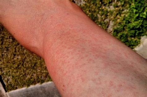 Maculopapular Rash Pictures Causes Treatment Definiti - vrogue.co