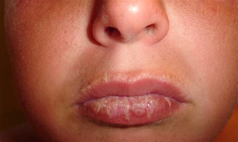 How To Tell If Your Lips Are Sunburnt | Lipstutorial.org