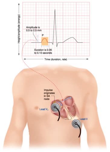 atrial enlargement & ventricular hypertrophy Flashcards | Quizlet