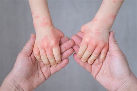 Как помочь, если у малыша высыпала аллергия? | MedAboutMe