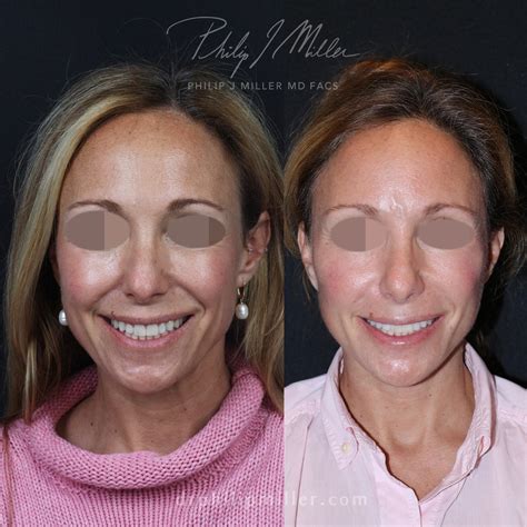 mini facelift   york city philip miller md