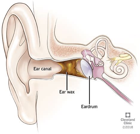 Earwax Buildup & Blockage | Cleveland Clinic | Impacted ear wax, Ear