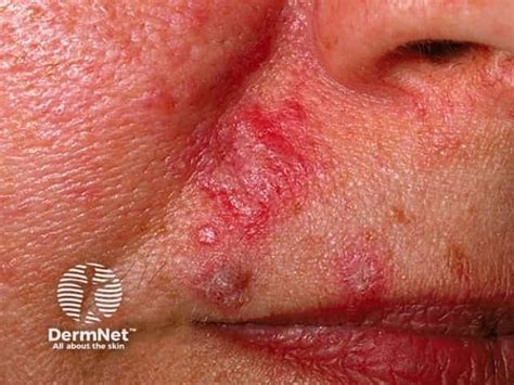 Lupus erythematosus images