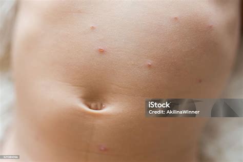 close   unrecognizable boys stomach  chickenpox stock photo