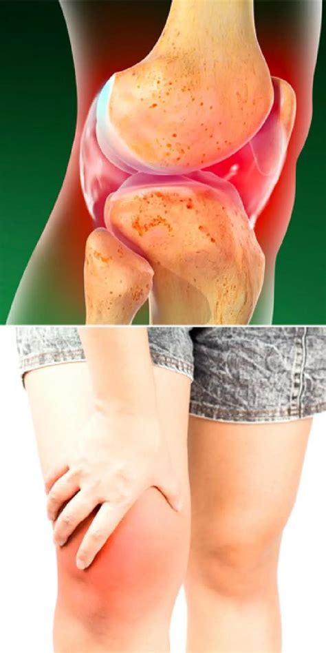 Septic Arthritis of the Knee | Orthopedic Surgery & Joint Replacement