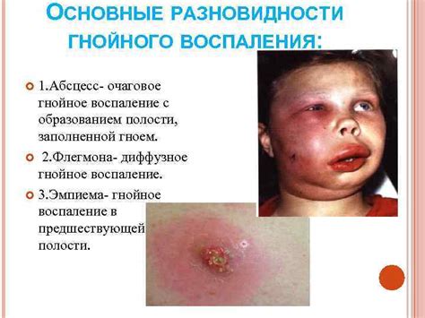ВОСПАЛЕНИЕ Подготовила: Сборец М. А. ВОСПАЛЕНИЕ