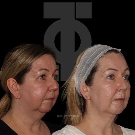 Endolift® Specialist in London | Dr Priya Verma