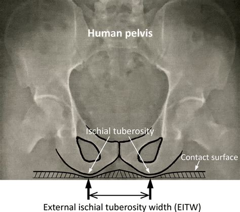schematic   external ischial tuberosity width eitw