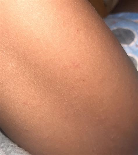 Does this look like scabies? : r/scabies