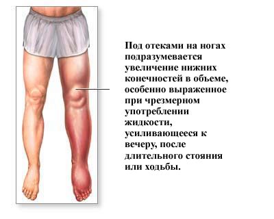 Отеки ног