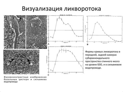 Гидроцефалия