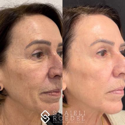 Ultraformer Antes E Depois Rosto