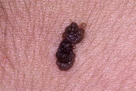 FDA Approves Topical Treatment for Seborrheic Keratoses - Dermatology ...
