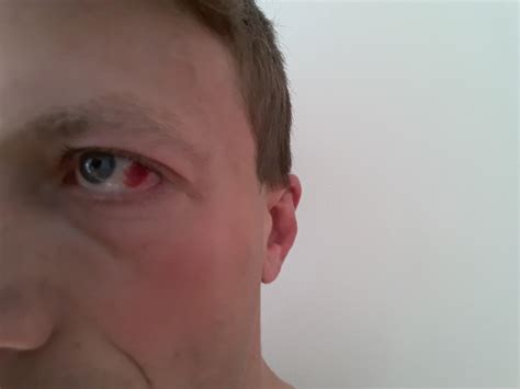 Popped a blood vessel in the eye. Should I stay away from training for