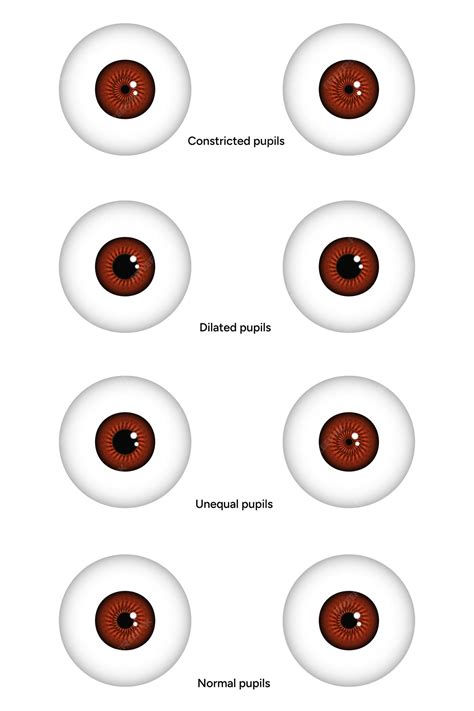 Premium Vector | Unequal Constricted Dilated and normal pupils eye