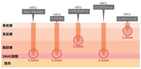 hifu