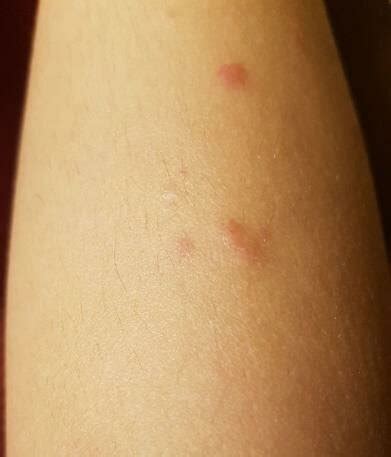 gambar  kanan lesi kulit  kaki bagian belakang pasien diawali