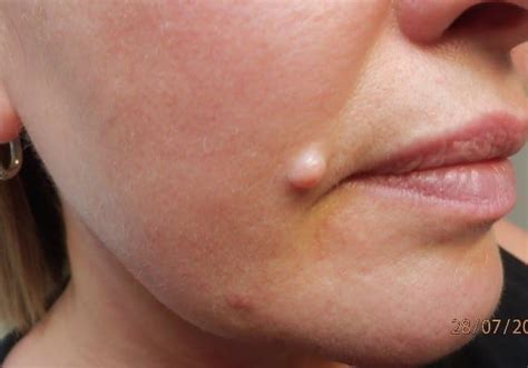 skin lesion removal mole removal treatment wart solihull medical