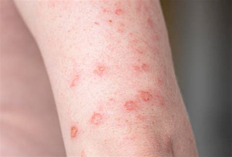 30+ Syphilis Rash Stock Photos, Pictures & Royalty-Free Images - iStock