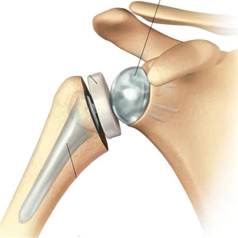 Shoulder Procedures - Premier Orthopedic Specialists of Tulsa