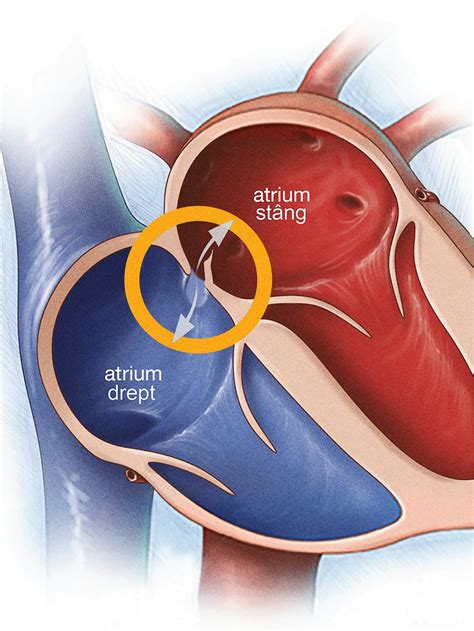 Foramen ovale patent - Cauze, simptome și tratament | ARES