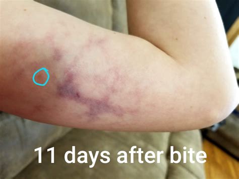 Confirmed Brown Recluse Bite : r/spiders