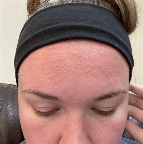 how to make a sunburn go away fast 5