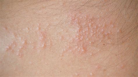 Rash On Back After Sweating at Homer Collins blog