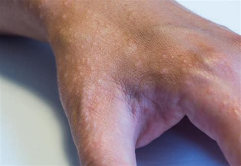6 types of eczema: Symptoms and causes