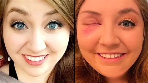 woman issues warning  unexpectedly losing  eye  minor car crash